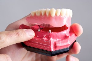 removabledentures